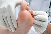امیدهای تازه درمان زخم های عفونی پای دیابتی